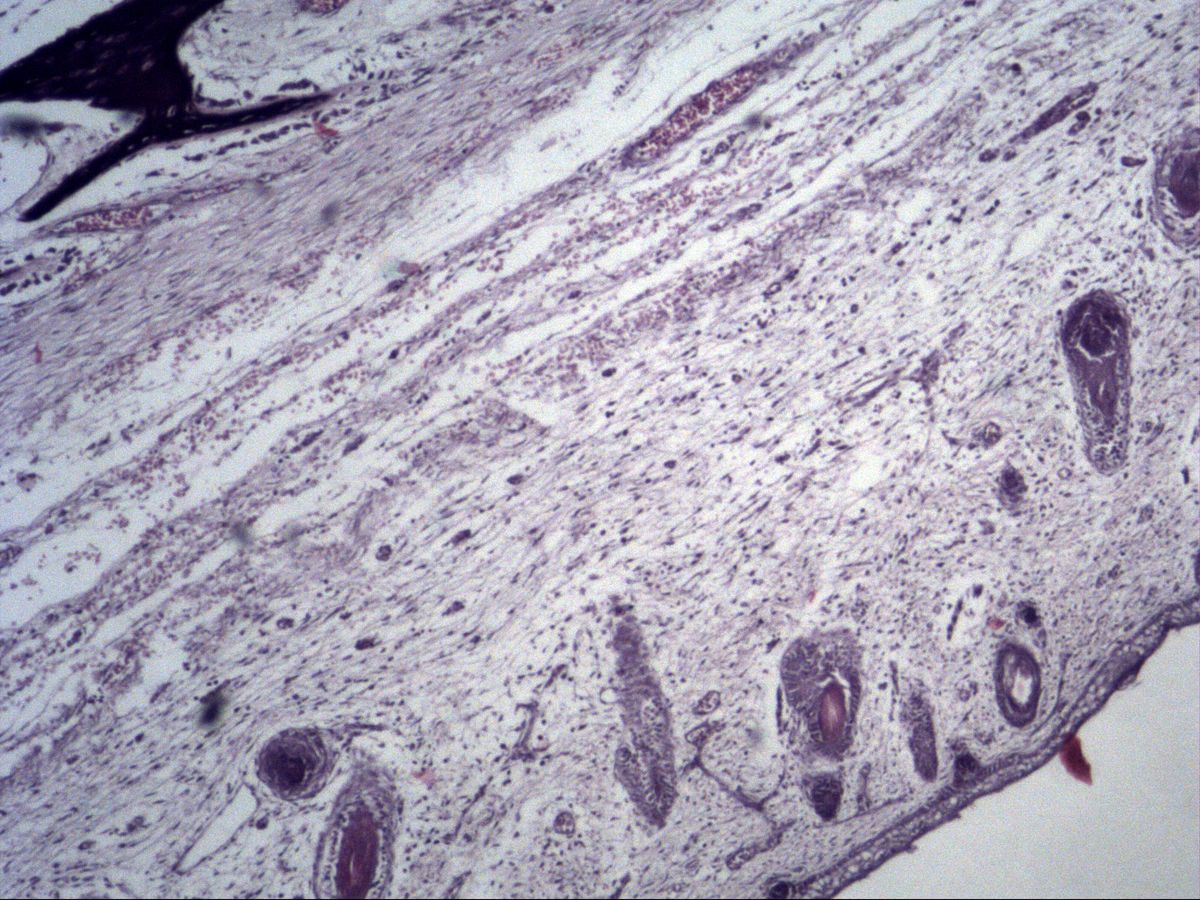 Fetal head tissue, H&E, overview with intramembranous bone trabecula in mesenchyme and hair follicle buds