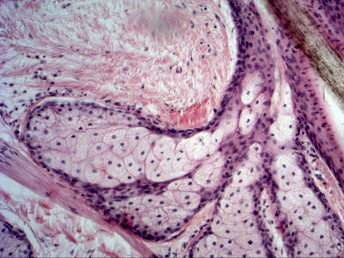 Scalp sebaceous gland, H&E: alveoli with basal cells, sebocytes and hair follicle