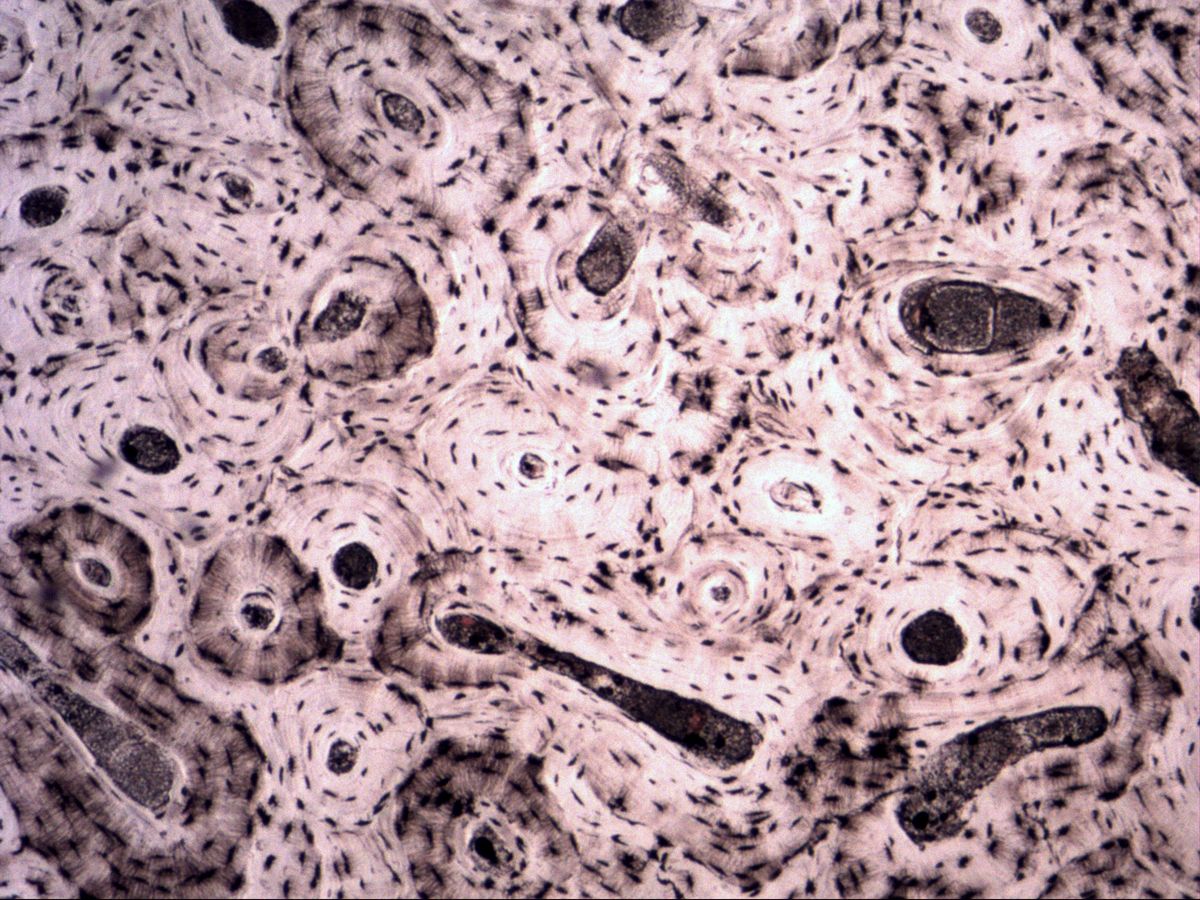 Bone ground section with osteons and an oblique Volkmann canal, overview